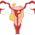 uterine fibroid homeopathic treatment