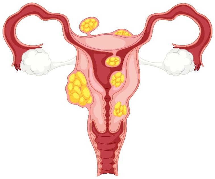 uterine fibroid homeopathic treatment