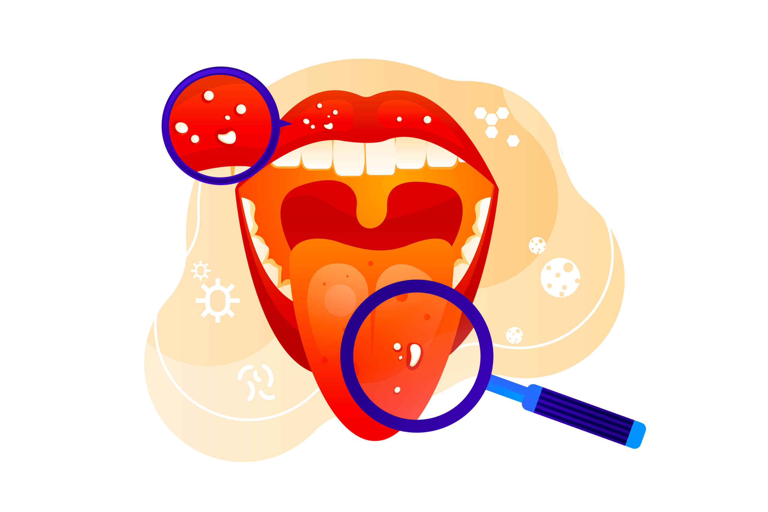 mouth-ulcers-dr-singh-s-homeopathy