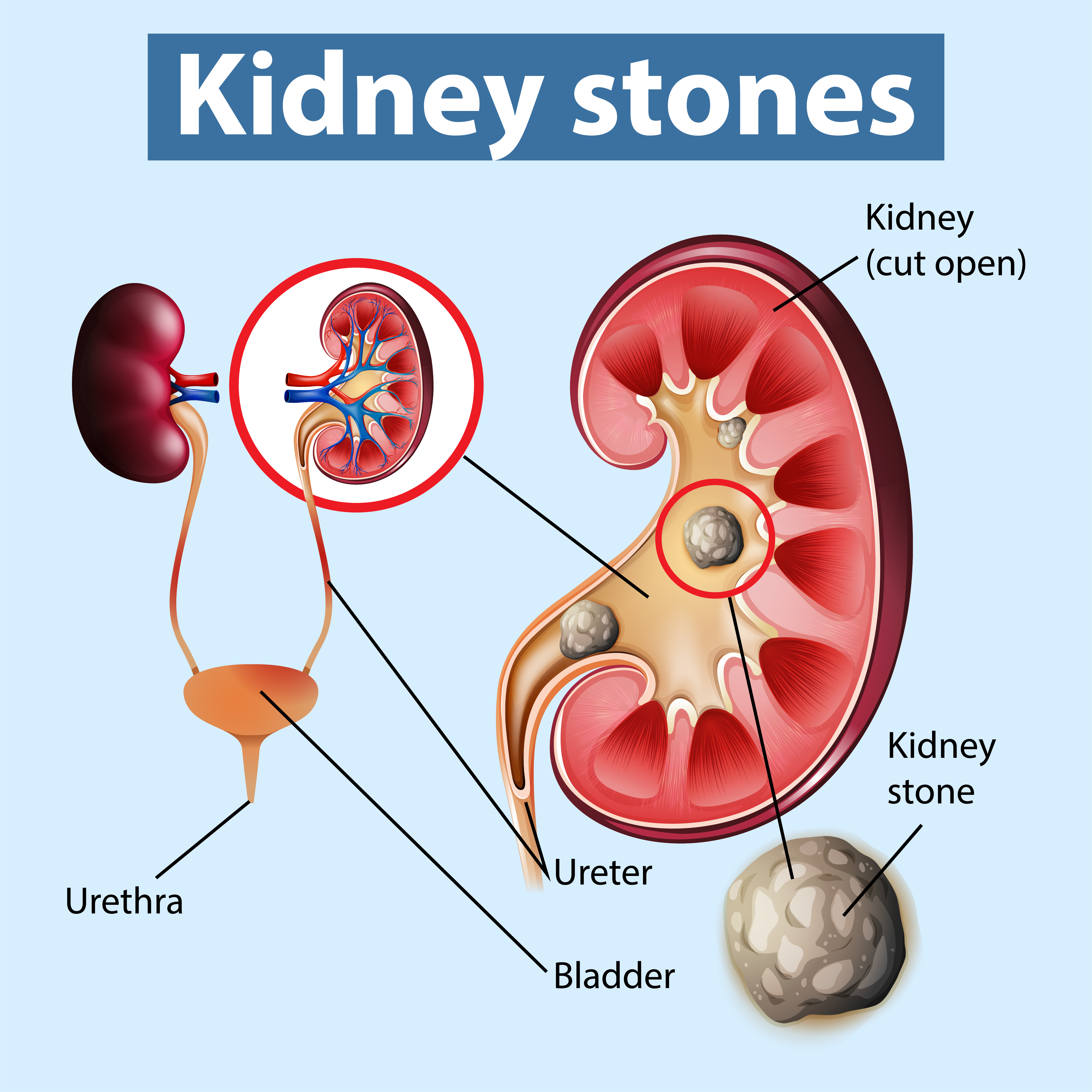 homeopathic treatment for renal stone